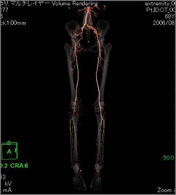 下肢動脈＋骨3D