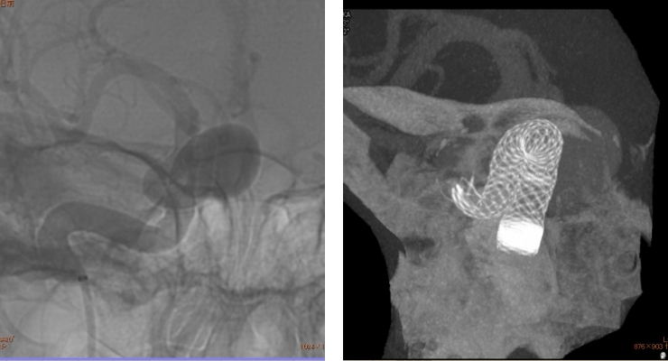 動脈瘤：フローダイバーターにより、脳動脈瘤にコイルを詰めずに治療可能