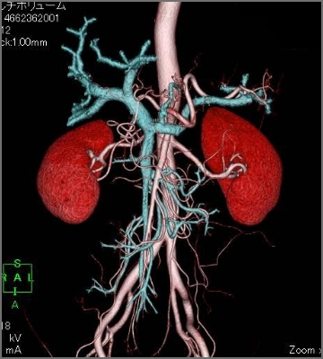 腹部血管3D