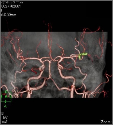 脳血管（クリッピング後）