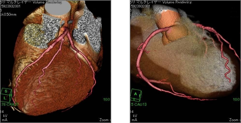 左：心臓冠動脈3D／右：心臓冠動脈3D