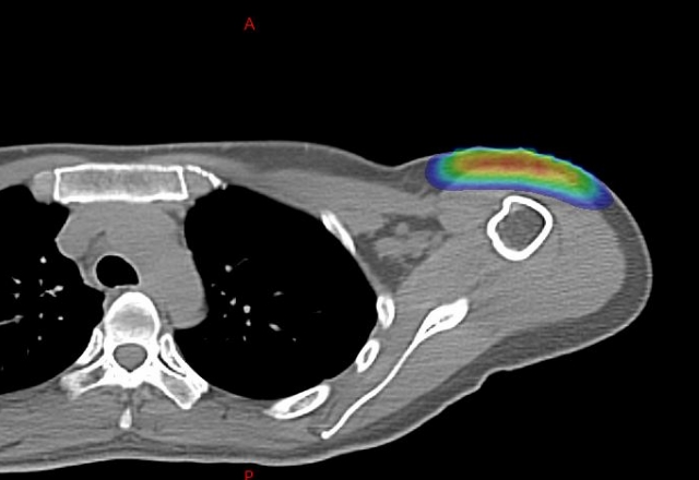 肩にあるケロイドの電子線照射