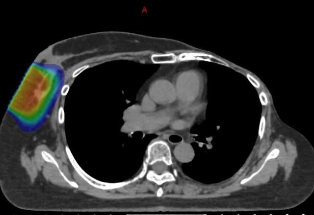 術後乳房の電子線での追加照射