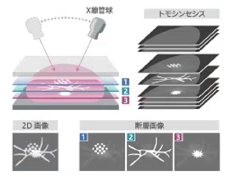 2D撮影では3つの病変が重なった写真しか撮れませんでしたが、3Dでは、画像を再構成することによって、3つの病変に焦点を合わせた画像ができるため観察がしやすくなります。