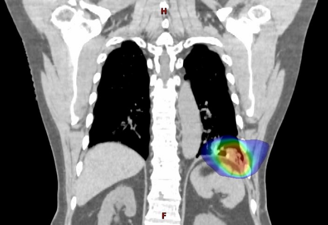 肺がんの定位照射