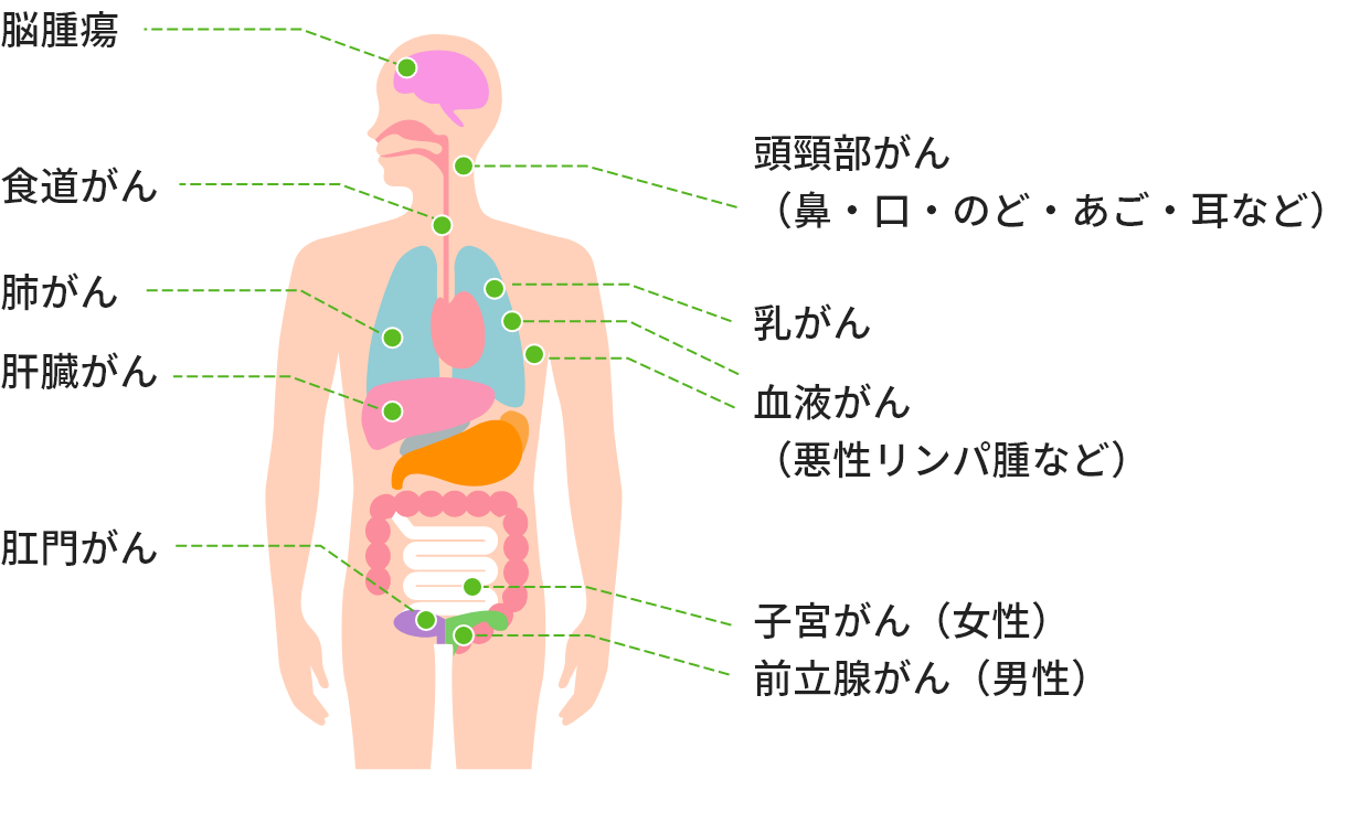 放射線治療が行われる主ながん