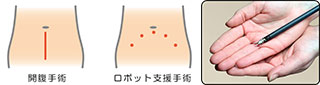 小さな傷で行う手術で、痛みも回復も軽減