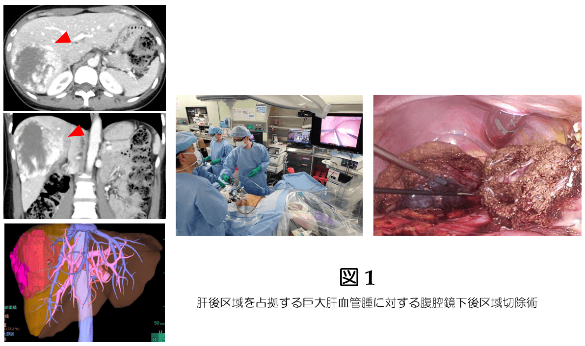 肝後区域を占拠する巨大肝血管腫に対する腹腔鏡下後区域切除術
