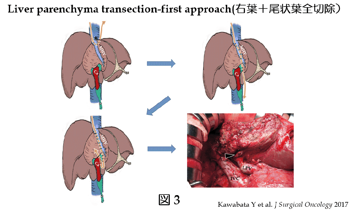 肝後区域を占拠する巨大肝血管腫に対する腹腔鏡下後区域切除術