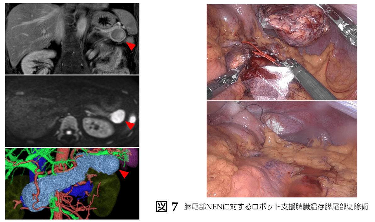 胆道癌に対する系統的腸間膜切除術