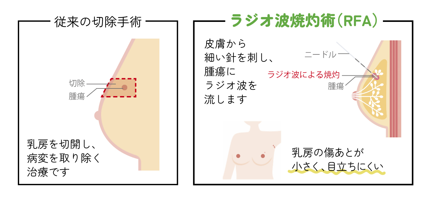 ラジオ波焼灼術